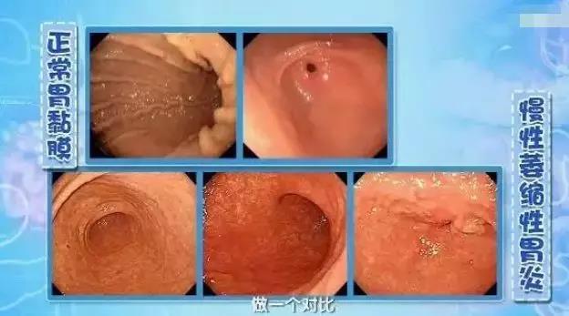 【荐读】肿瘤来之前，都会有“瘤前病变”!很多人没重视(图2)