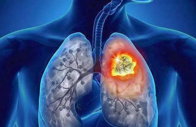 【荐读】肿瘤来之前，都会有“瘤前病变”!很多人没重视(图4)