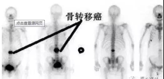 【肿瘤转移】肿瘤细胞喜欢转移到哪些部位?(图1)