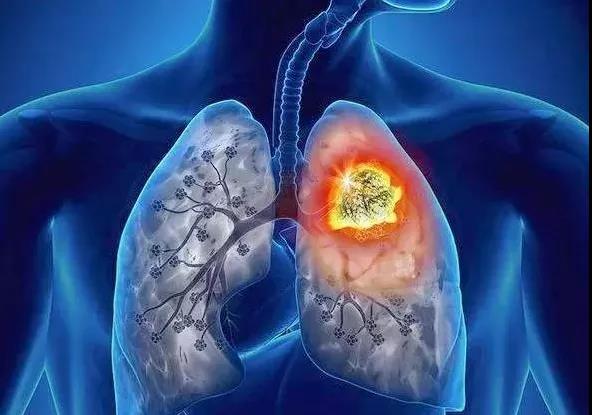 肺结节离肺癌到底有多远？(图1)