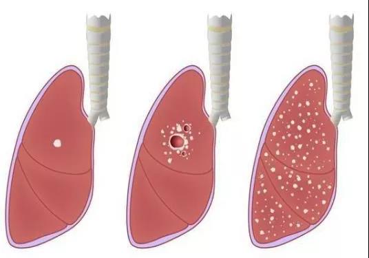肺结节离肺癌到底有多远？(图2)