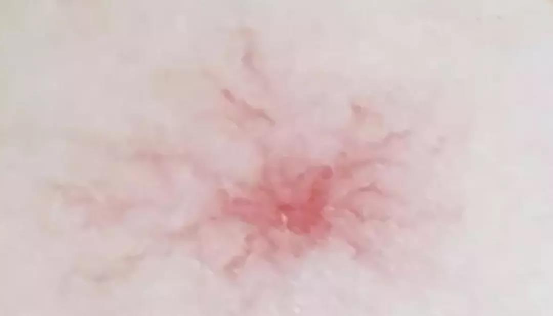 【提醒】关于脂肪肝有2个误区，日常做到这几点，帮助改善(图3)