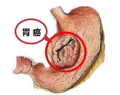 胃癌
