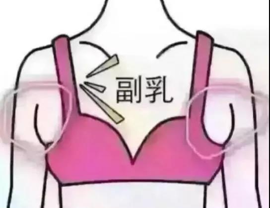 副乳的危害
