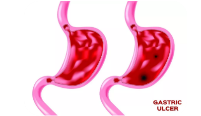 众多90后胃癌晚期!为所有人敲响警钟!(图2)