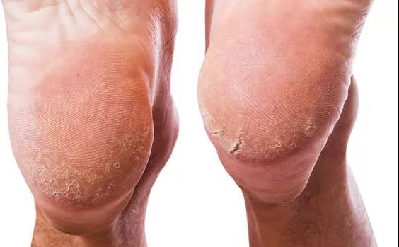 肝不好，脚先知，一旦有这些症状说明肝在求救(图3)