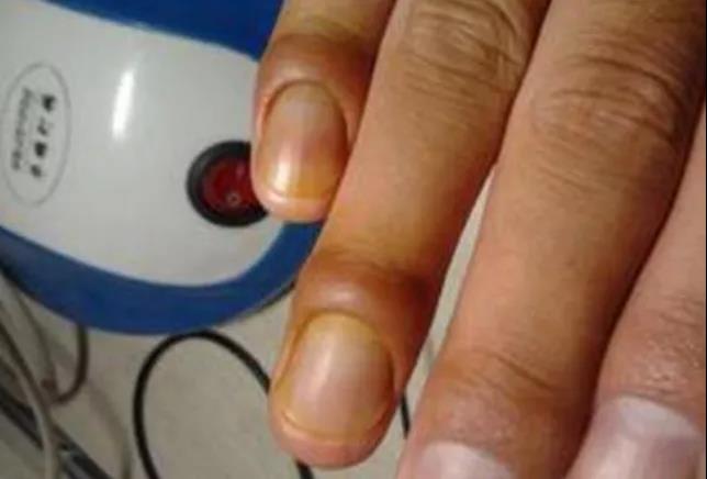 手指甲长这样，可能是肝脏在“求救”!(图3)
