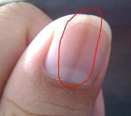 手指甲长这样，可能是肝脏在“求救”!(图2)