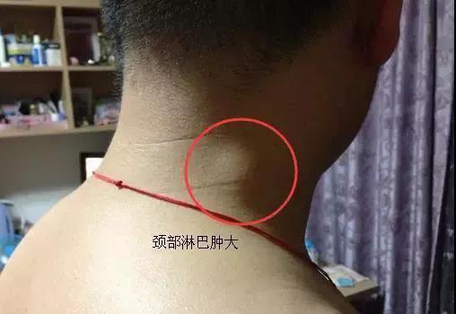 癌细胞发生转移的四个方式!做好以下五点,癌症远离你(图3)