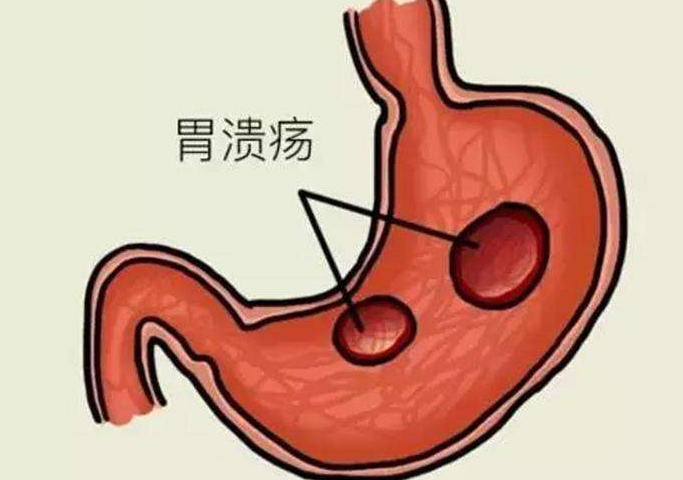 别等“胃病”拖成“胃癌”!这4种小病，最好及时治疗(图2)