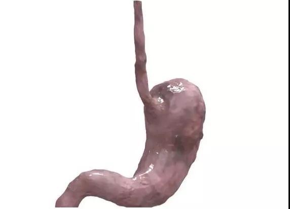 27岁女子，从胃痛到查出胃癌仅3周!医生：这3类人最危险(图2)