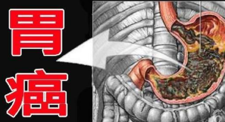 27岁女子，从胃痛到查出胃癌仅3周!医生：这3类人最危险(图3)