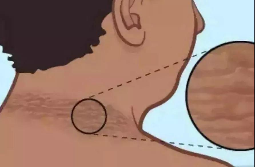 警惕!脖子这4个迹象，暗示癌细胞已“苏醒”(图2)