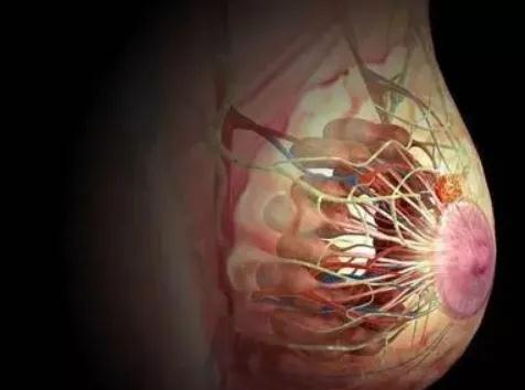 女人必看!自己如何分辨乳腺结节是良性还是恶性?(图2)