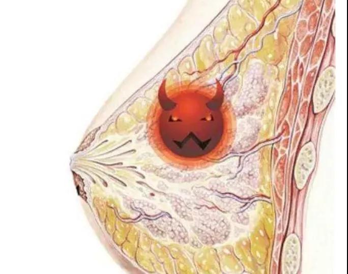 女人必看!自己如何分辨乳腺结节是良性还是恶性?(图3)
