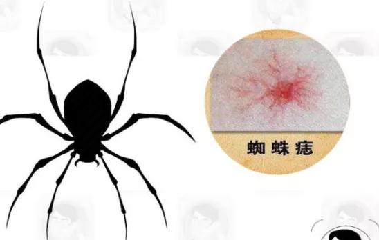 肿瘤医生：身体3个地方长黑痣，不可大意，可能是癌“(图2)