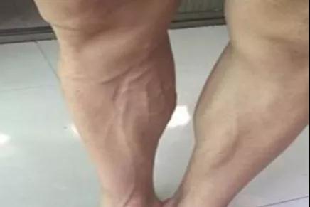 “青筋爆，大病到”这些部位出现青筋，千万不要忽视!(图4)