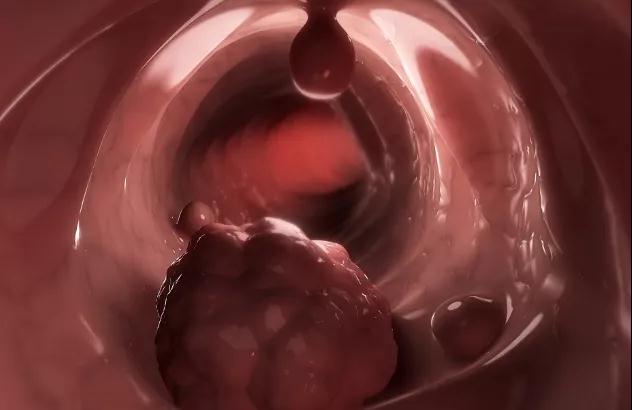 吓人!14个肠镜中13个有癌前病变，1个确诊肠癌!(图2)