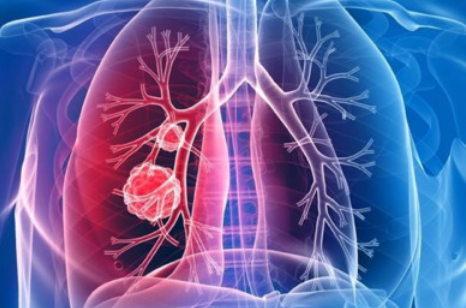 都是肺癌，肺腺癌和肺鳞癌有什么不同?(图2)