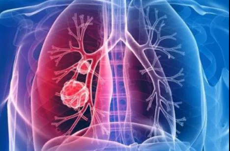 都是肺癌，肺腺癌和肺鳞癌有什么不同？(图2)