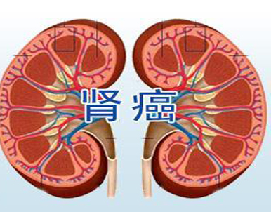 这种癌症常被误诊为高血压，无论男女一定要引起注意!(图2)