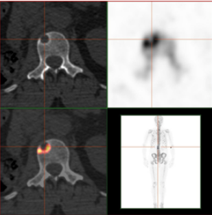 得了癌症最怕听到“骨转移”，哪些征兆表明癌症开始“啃(图2)