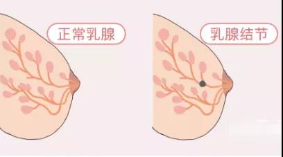 乳腺增生、结节、癌,摸起来是啥感觉?医生教你分辨(图3)