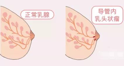 乳腺增生、结节、癌,摸起来是啥感觉?医生教你分辨(图5)