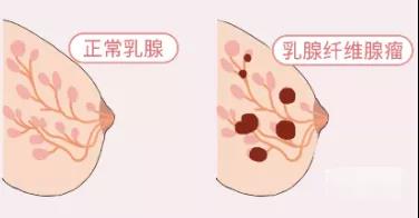 乳腺增生、结节、癌,摸起来是啥感觉?医生教你分辨(图4)