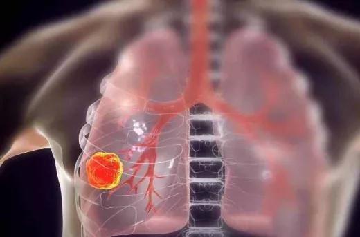 癌症真相：癌前病变距离癌症有多远?这7种病症要抓紧治疗(图6)