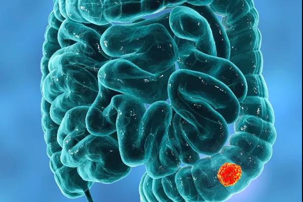 癌症真相：癌前病变距离癌症有多远?这7种病症要抓紧治疗(图4)