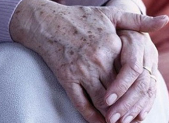 警惕!年轻人也会长老年斑，别把皮肤癌误当成为老年斑(图3)