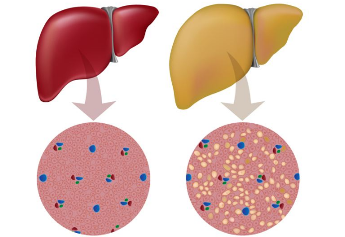 不吃晚饭就能摆脱脂肪肝吗?(图2)