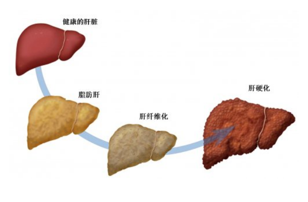 超40%成年人被脂肪肝“绑架”!颈围超过这个数要当心(图2)