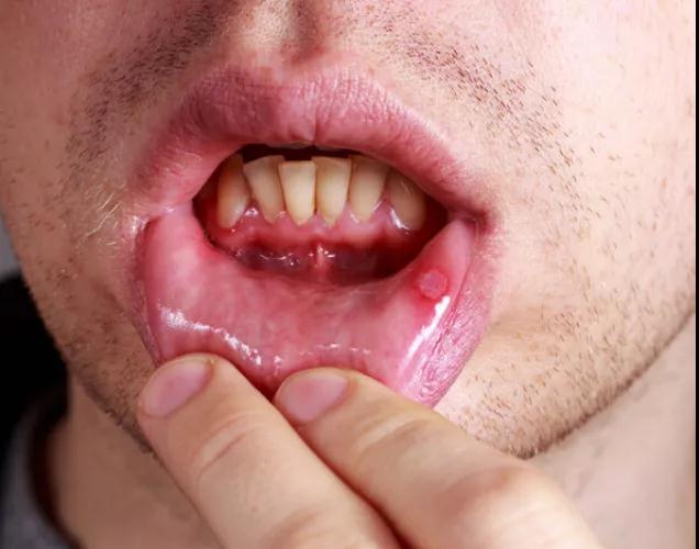 口腔溃疡是上火、缺维生素，多吃水果?错!(图2)