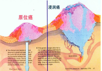 原位癌、浸润癌、原发癌、转移癌，到底有什么不同?(图2)