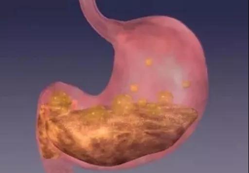 常常胃灼热需要警惕三种癌症!(图2)