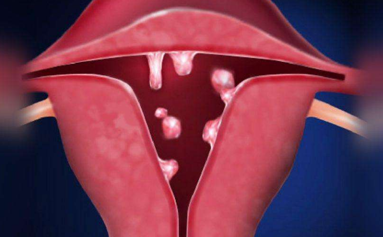 肠息肉、胃息肉、胆囊息肉、子宫息肉、鼻息肉与癌的关系(图3)