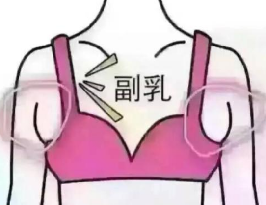 副乳会不会癌变?医生：出现这些情况要警惕!(图3)