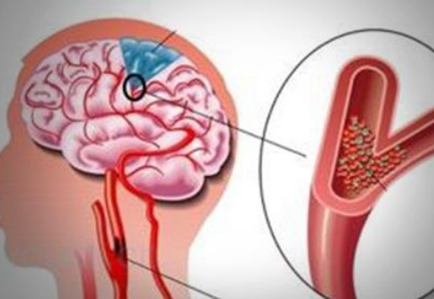 为什么颈动脉最容易堵? 如何发现颈动脉异常?(图3)