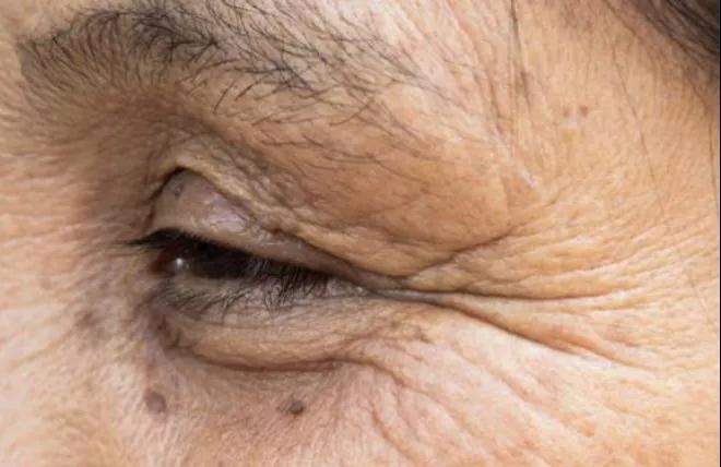 体内有癌，眼睛先知，若出现这些变化，尽快去医院检查(图2)