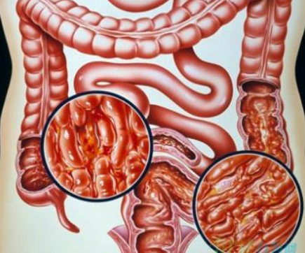 让安倍晋三辞职的“溃疡性结肠炎”，到底怎么回事?(图3)