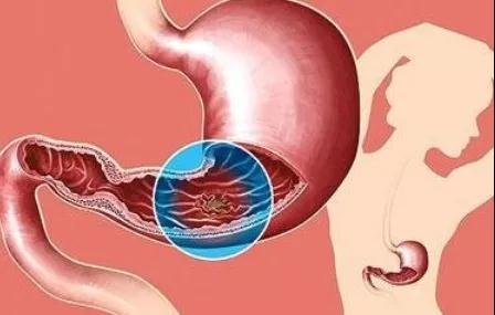它是预防胃癌的第一道关卡，90%的胃病患者都没保护好(图2)