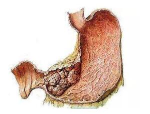 远离消化道肿瘤，必须注意这5点!(图2)