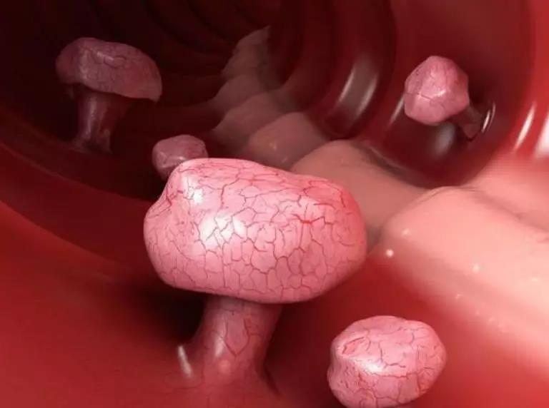 【肿瘤科普】结节、息肉、囊肿、增生,哪个才是肿瘤先兆?(图2)