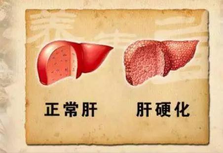 肝硬化会发出“1痒、2黄、3舌”的求救信号，占一个也要查(图2)