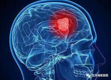 【健康】脑瘤发出的早期信号，90%的人都忽略了!(图1)