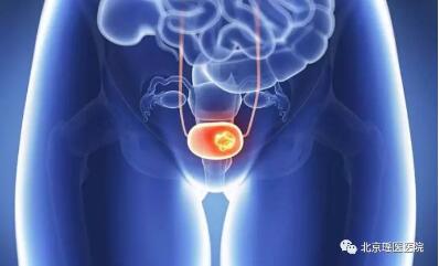 【科普】为什么膀胱肿瘤偏爱男性?多种习惯很多人都有(图2)