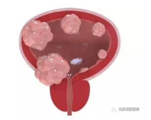 【科普】为什么膀胱肿瘤偏爱男性?多种习惯很多人都有(图1)