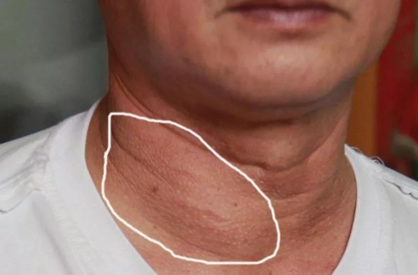 “甲状腺癌”不会无端出现，身体3个表现，可能它已....(图1)